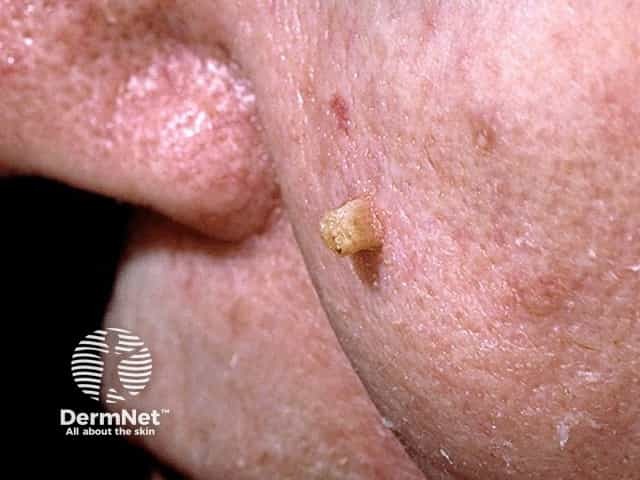 Cutaneous horn