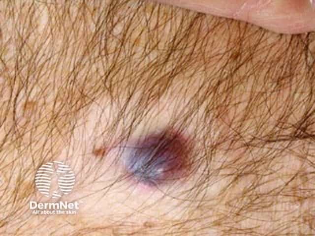 Metastatic melanoma