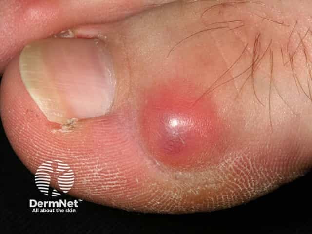 Myxoid cyst