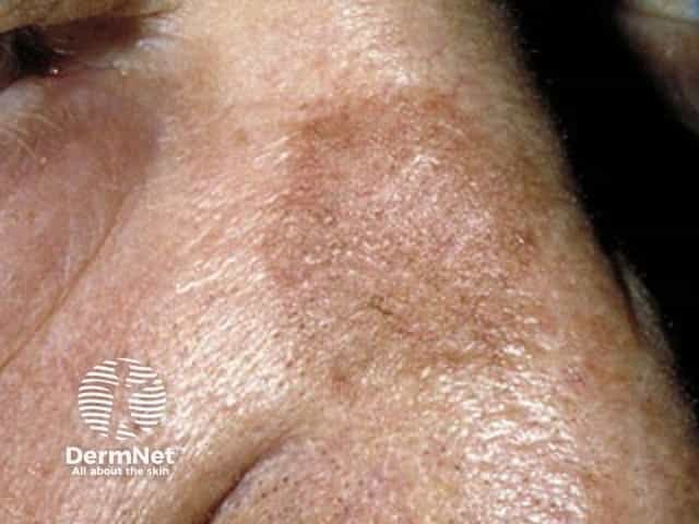 Actinic keratosis