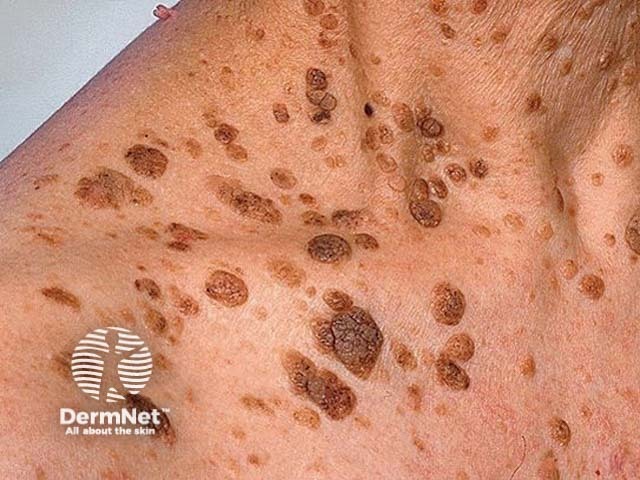 Seborrhoeic keratosis