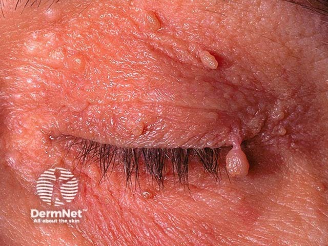 Seborrhoeic keratosis