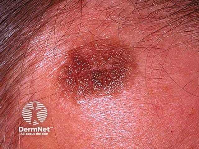 Seborrhoeic keratosis