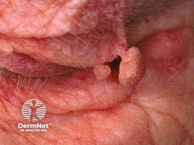 Seborrhoeic keratosis