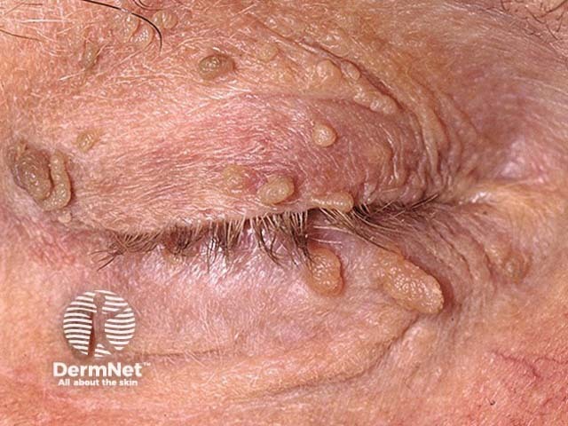 Seborrhoeic keratosis