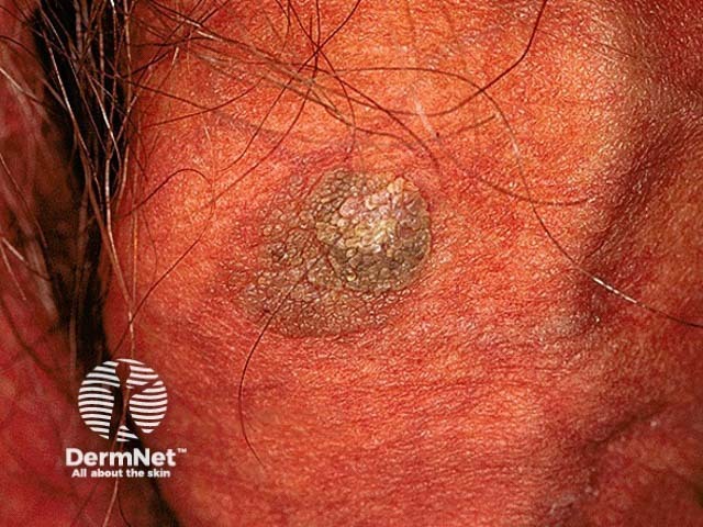 Seborrhoeic keratosis