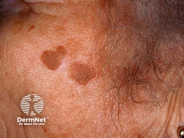 Seborrhoeic keratosis