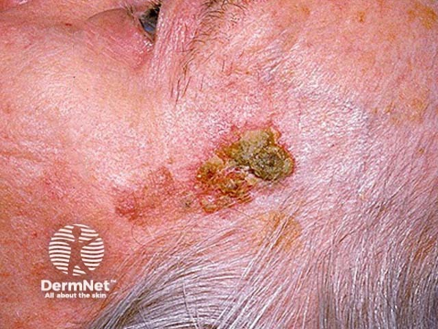 Seborrhoeic keratosis