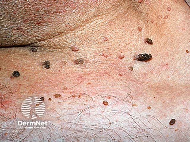 Seborrhoeic keratosis