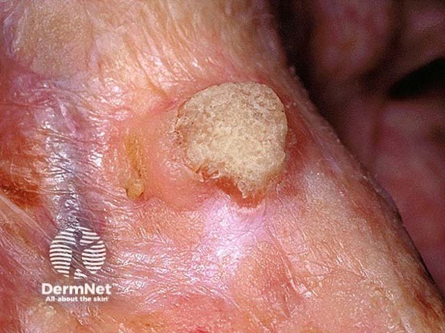 Seborrhoeic keratosis