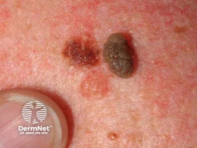 Seborrhoeic keratosis