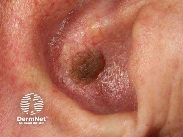 Seborrhoeic keratosis