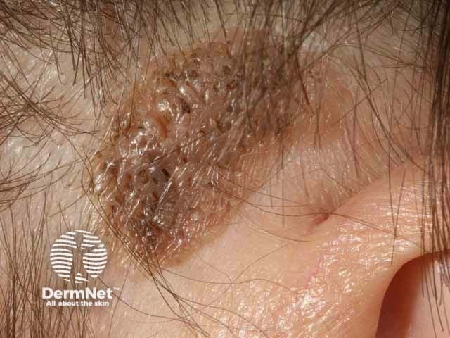 Seborrhoeic keratosis