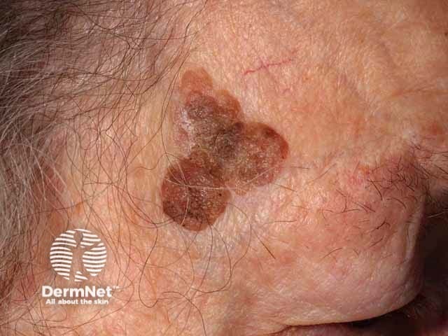 Seborrhoeic keratosis