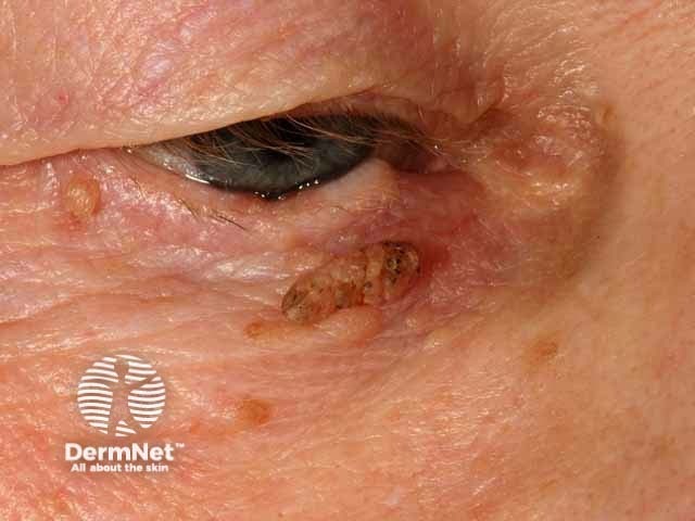 Seborrhoeic keratosis