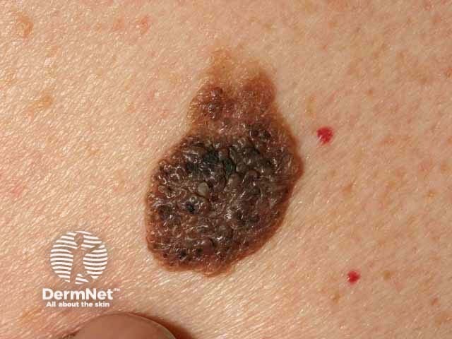 Seborrhoeic keratosis