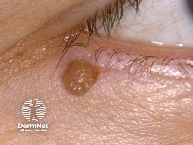 Seborrhoeic keratosis