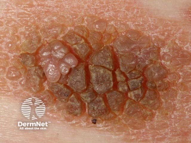 Seborrhoeic keratosis