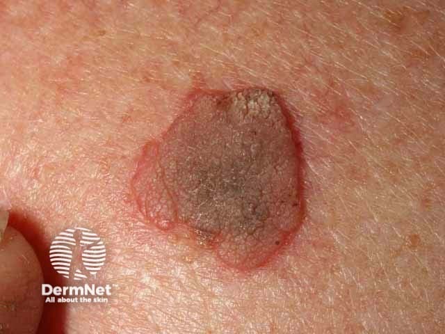 Seborrhoeic keratosis