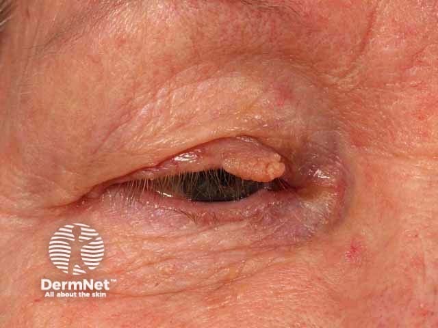 Seborrhoeic keratosis