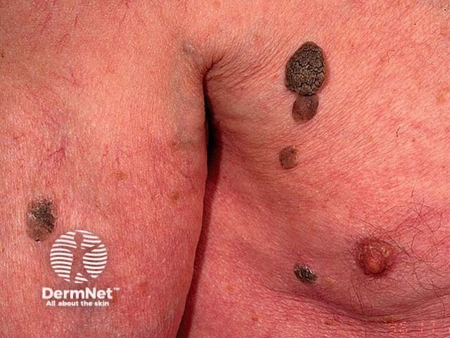 Seborrhoeic keratosis