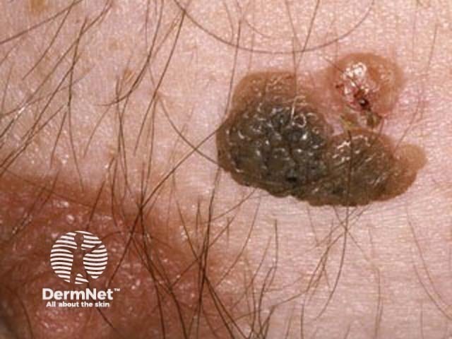 Seborrhoeic keratosis