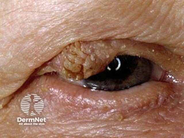 Seborrhoeic keratosis