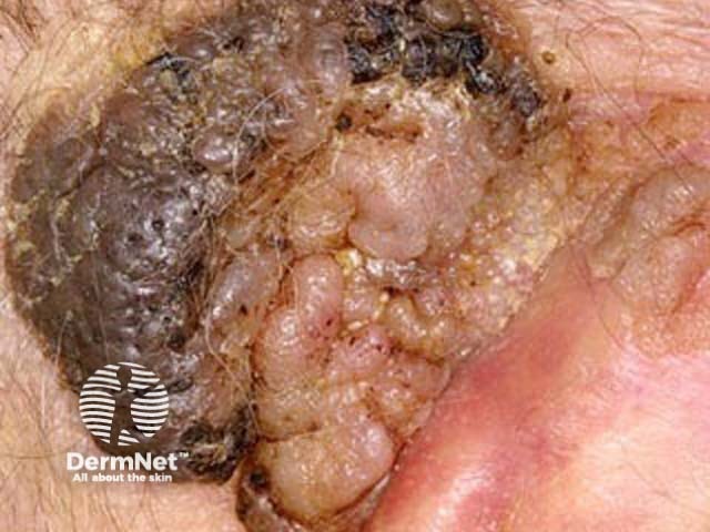 Seborrhoeic keratosis