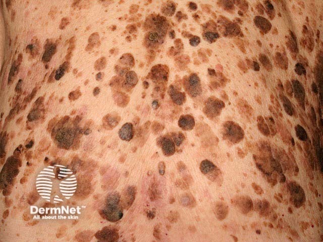 Seborrhoeic keratosis