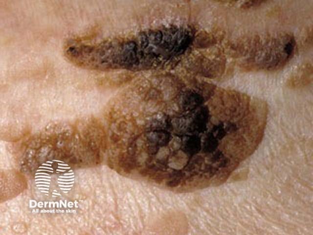 Seborrhoeic keratosis