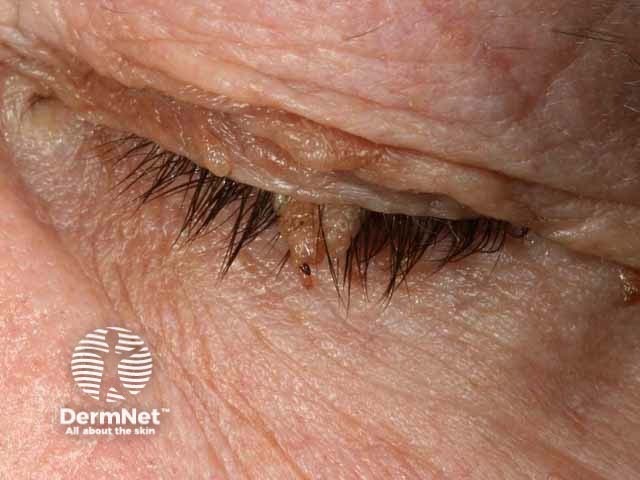 Seborrhoeic keratosis