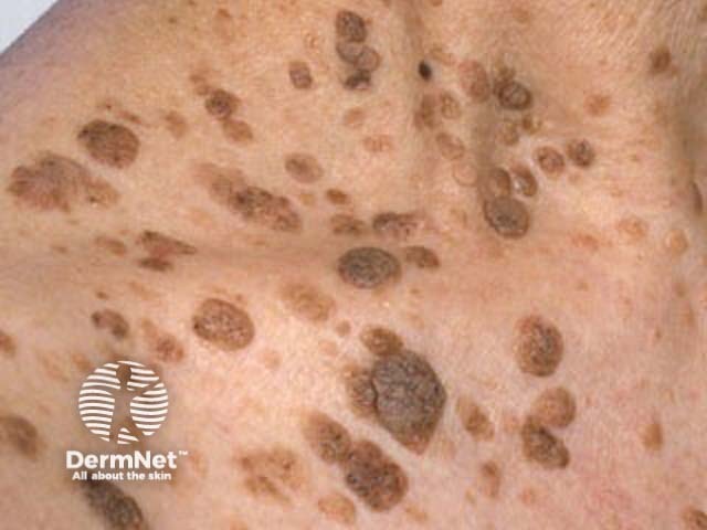 Seborrhoeic keratosis