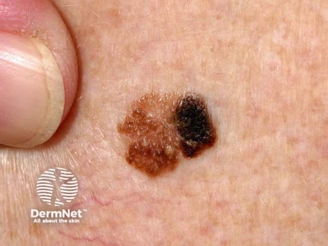 Seborrhoeic keratosis