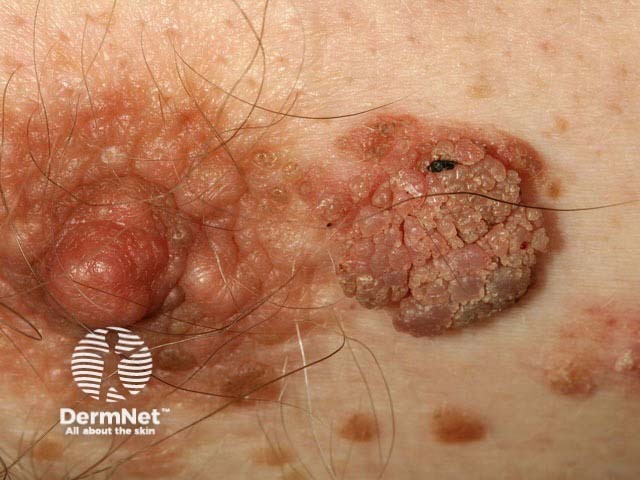 Seborrhoeic keratosis