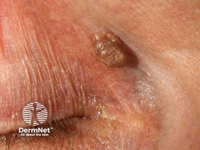 Seborrhoeic keratosis