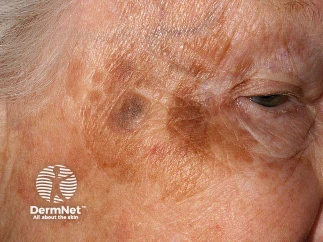 Seborrhoeic keratosis