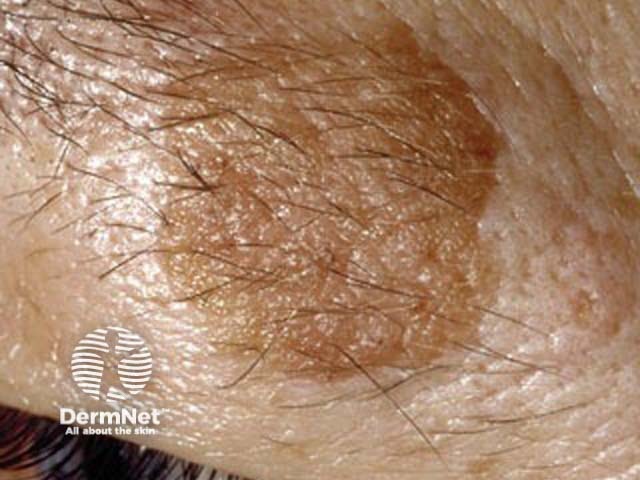 Seborrhoeic keratosis