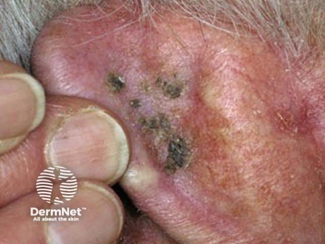 Seborrhoeic keratosis