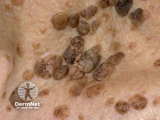 Seborrhoeic keratosis