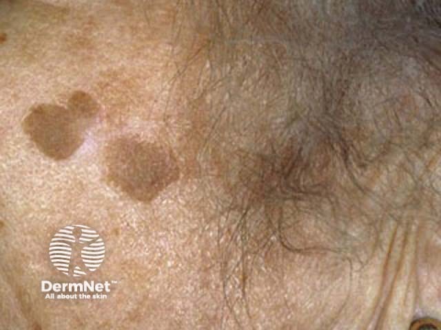 Seborrhoeic keratosis