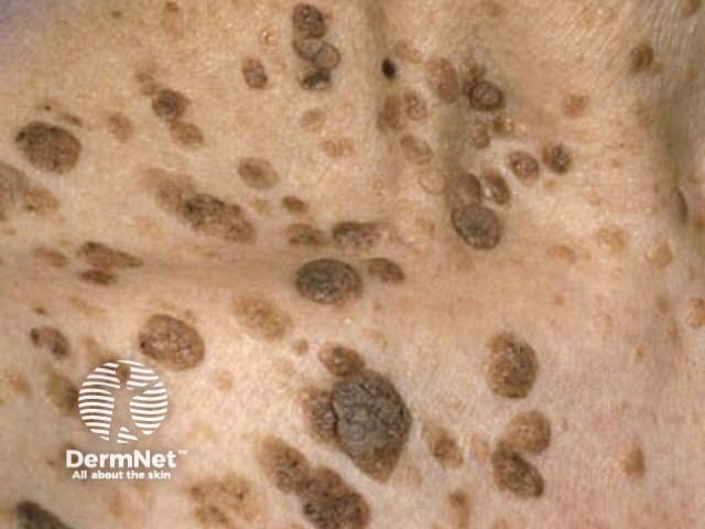 Seborrhoeic keratosis