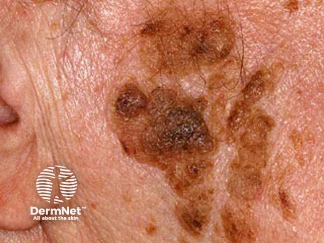 Seborrhoeic keratosis