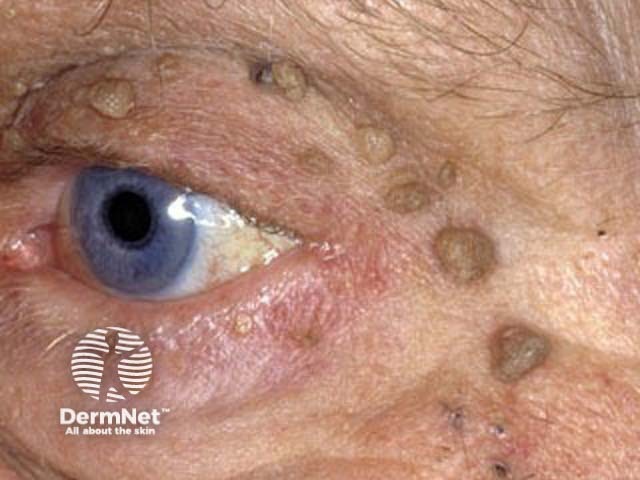 Seborrhoeic keratosis