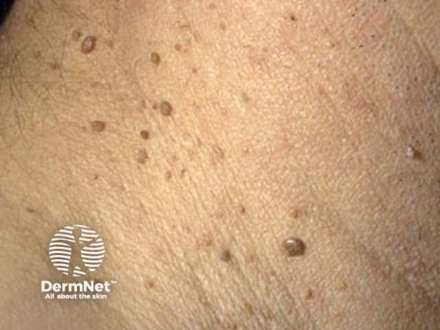 Seborrhoeic keratosis