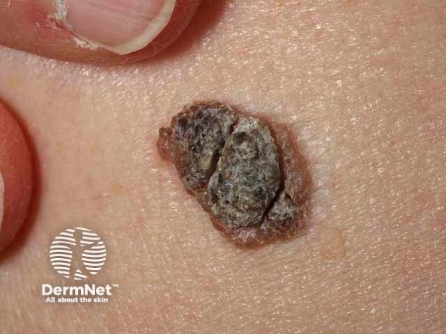 Seborrhoeic keratosis