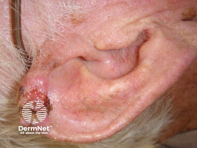 Squamous cell carcinoma