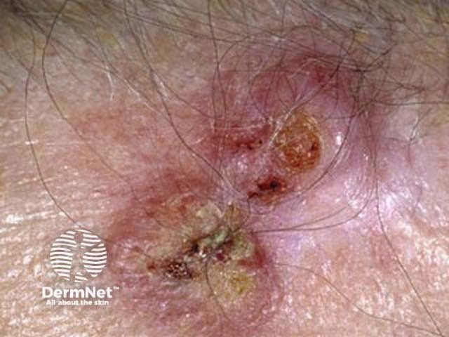 Squamous cell carcinoma on the face