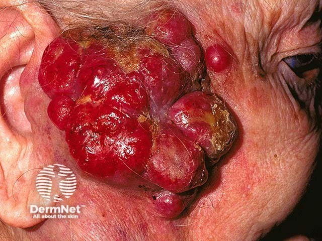 Squamous cell carcinoma on the face