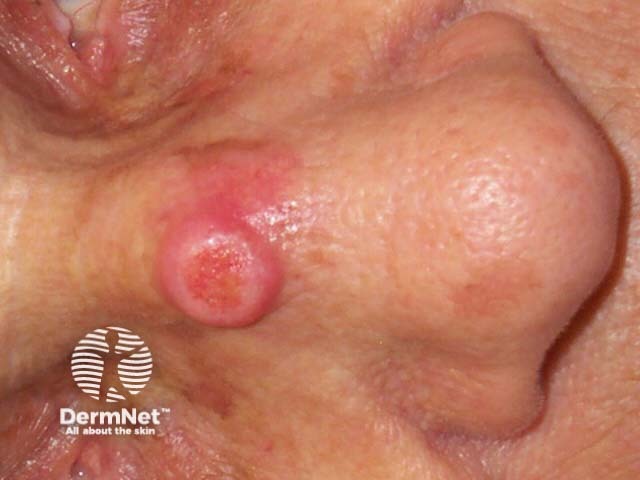 Squamous cell carcinoma on the face