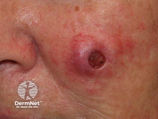 Squamous cell carcinoma on the face